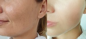 Jaw Surgery Cost for contouring jaw structure