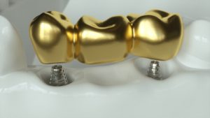 gold tooth implant cost