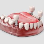 dental implant cost near me