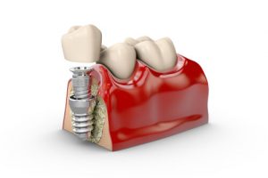 dental implant cost near me