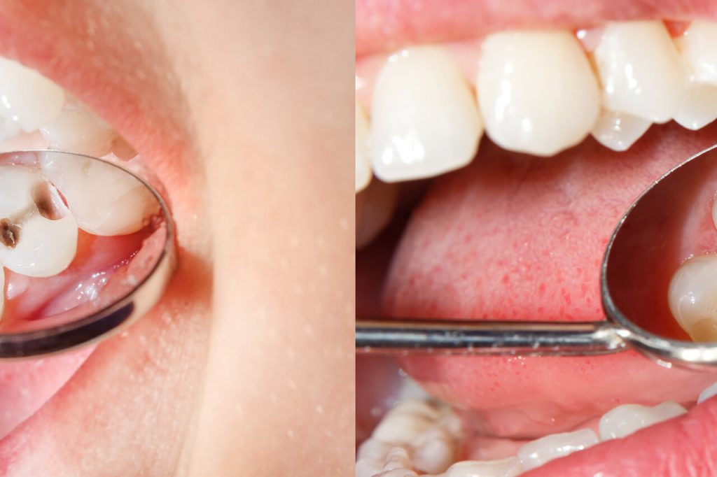 composite tooth fillings