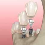 sample mini dental implants