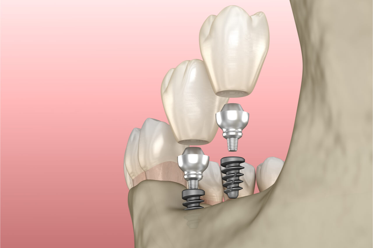 sample mini dental implants