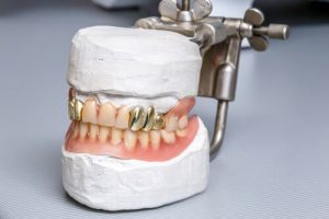 gold dental restoration